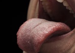 5 Fakta Menarik tentang Sariawan, Gak Cuma Gegera Kurang Vit-C
